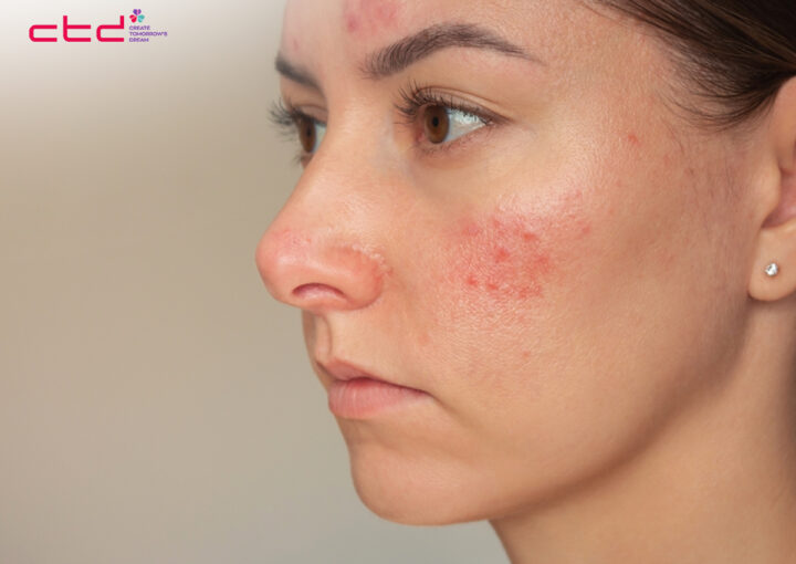 Skincare Tips for Acne Skin